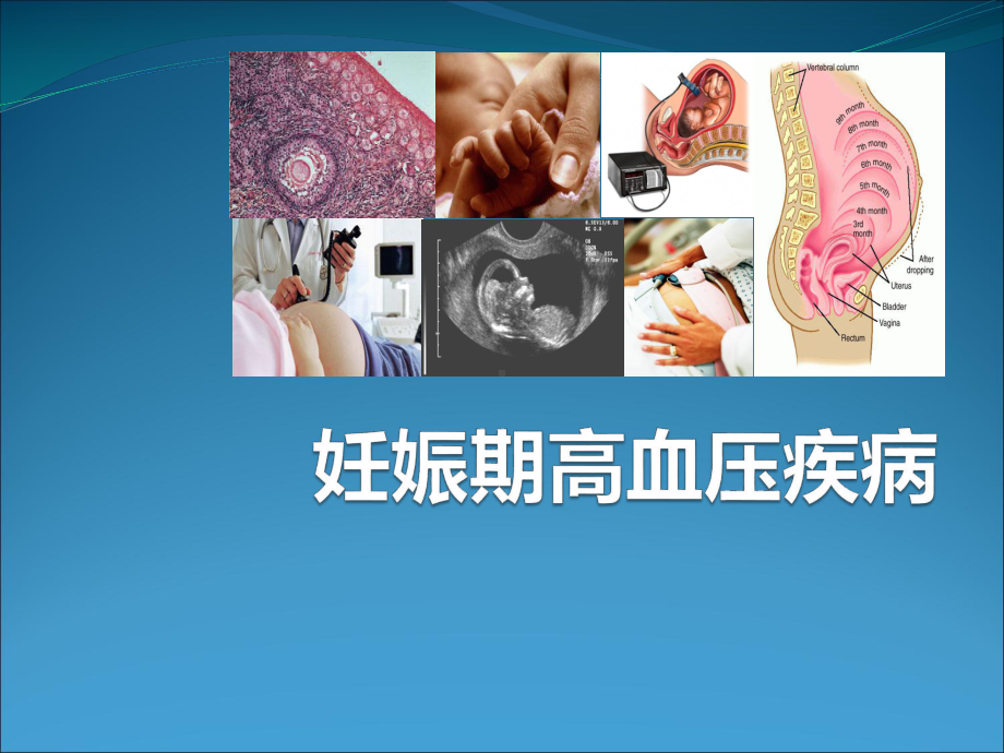 妇产科学-妊娠期高血压疾病课件.ppt_第1页