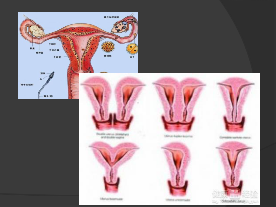 子宫畸形及三维成像课件.ppt_第3页
