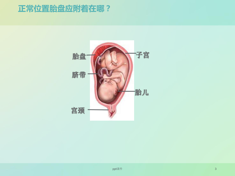 前置胎盘-ppt课件1.ppt_第3页