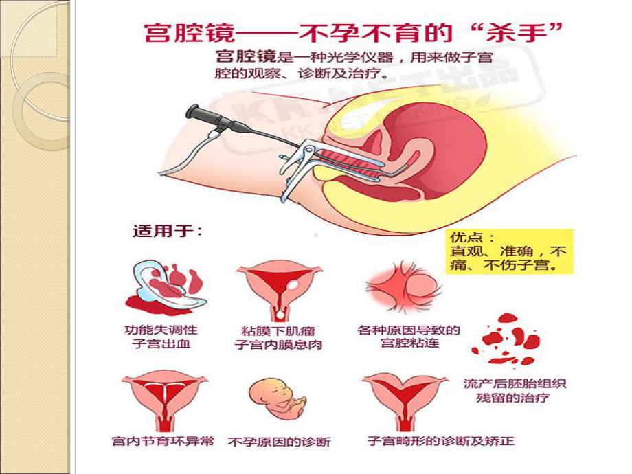 宫腔镜在妇科临床的应用基础知识 课件.ppt_第3页