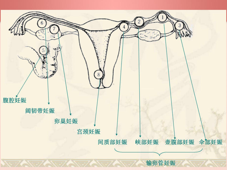 异位妊娠护理查房1课件.pptx_第3页