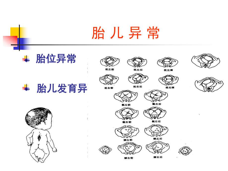 异常分娩、胎位异常课件.ppt_第3页