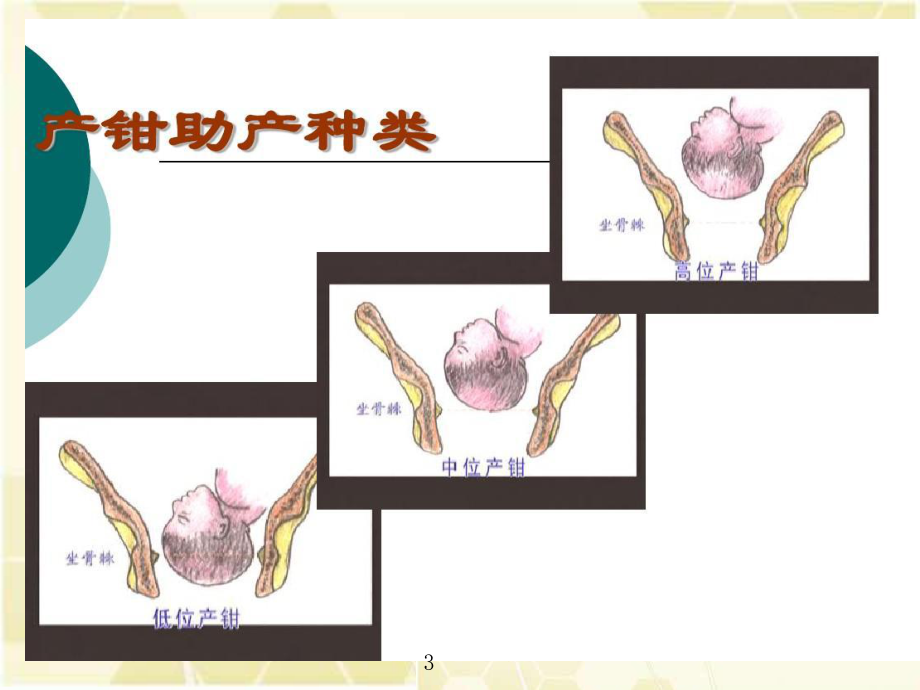 产钳助产后的护理PPT课件.pptx_第3页