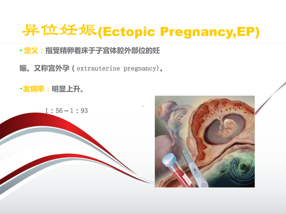 妇产科急症之异位妊娠PPT课件.ppt_第2页