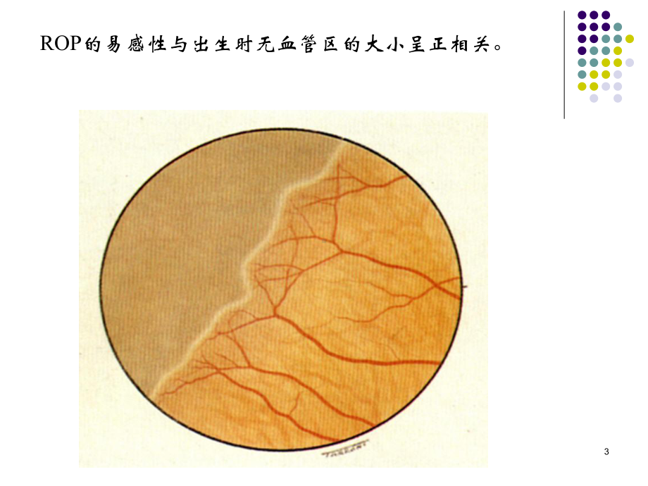 早产儿视网膜病PPT课件1.ppt_第3页