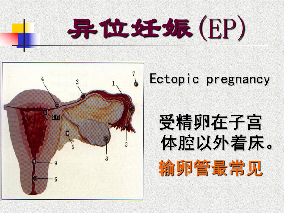 异位妊娠ppt课件.ppt_第1页