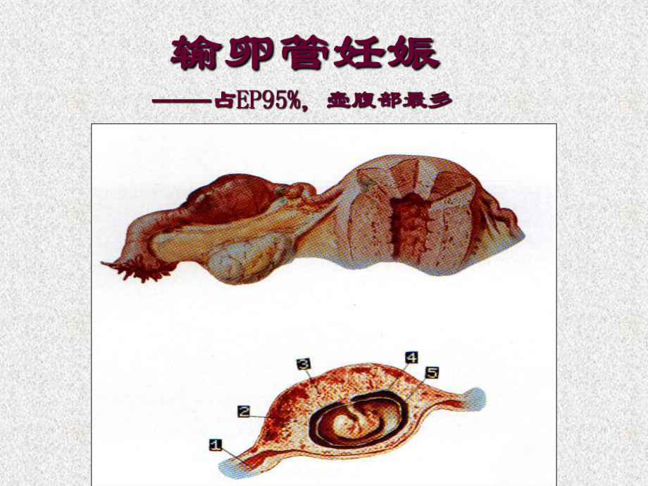 异位妊娠ppt课件.ppt_第2页