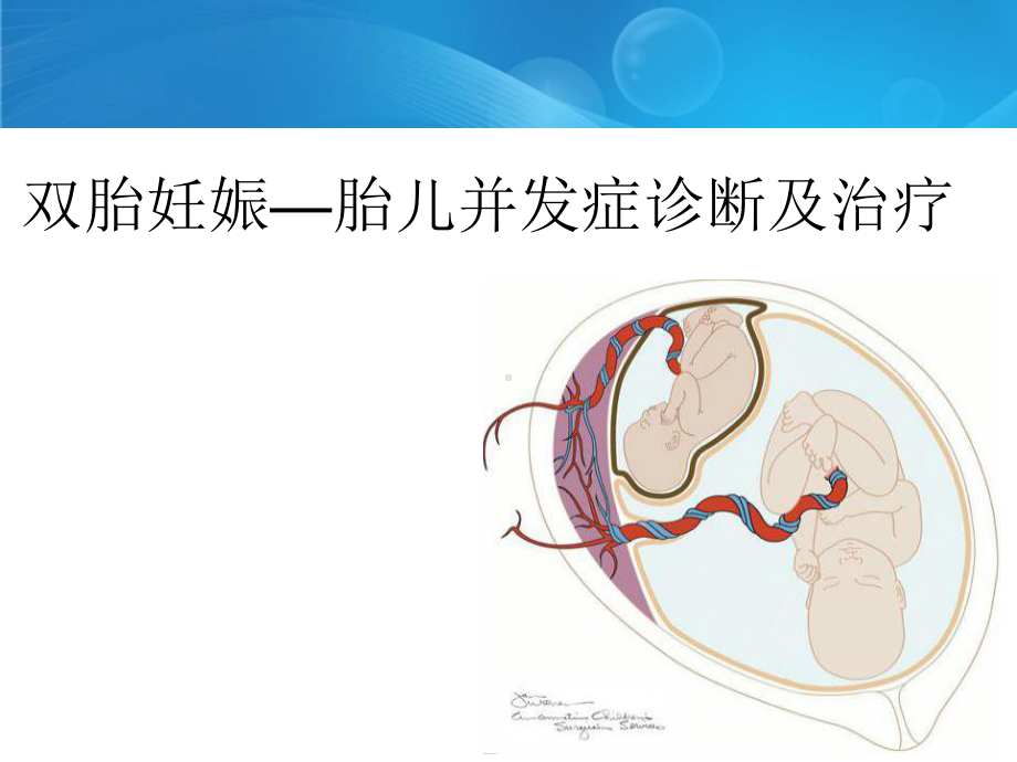 双胎妊娠特有并发症课件.ppt_第1页