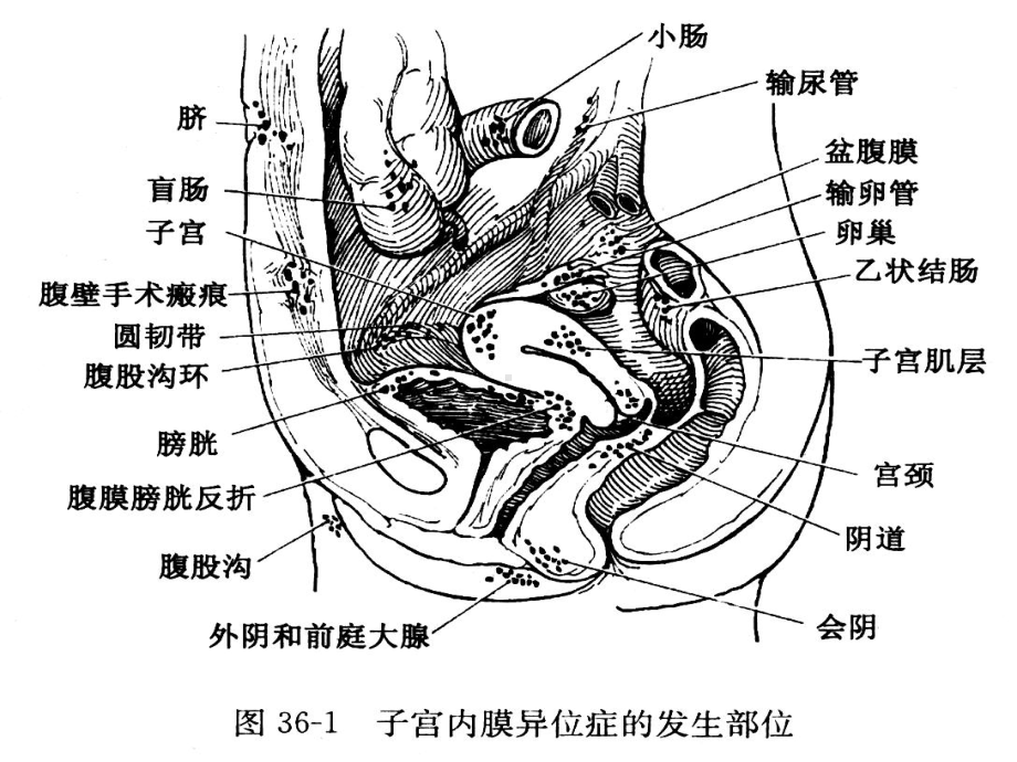 子宫内膜异位症 PPT课件.ppt_第3页