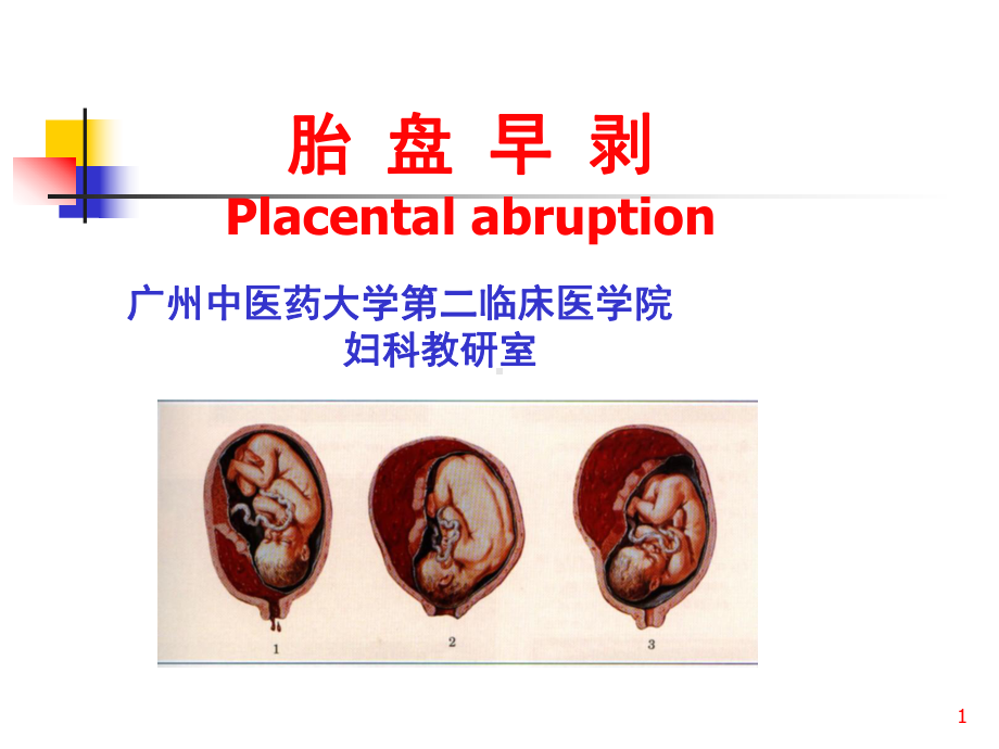 中西医结合胎盘早剥课件.ppt_第1页