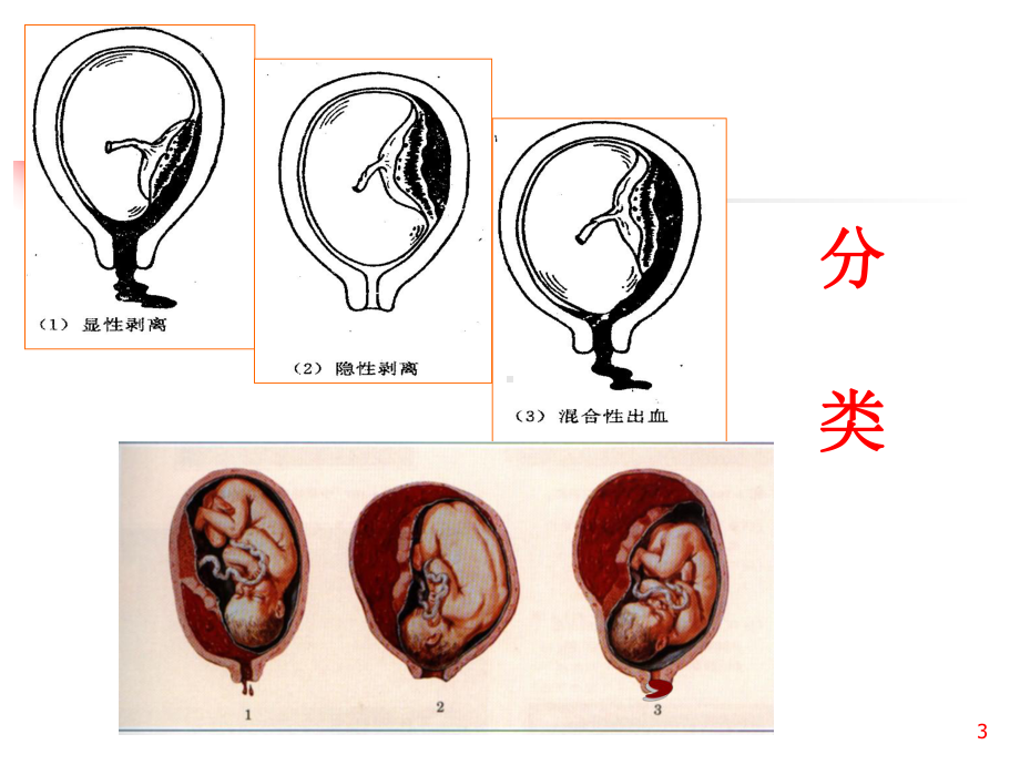 中西医结合胎盘早剥课件.ppt_第3页