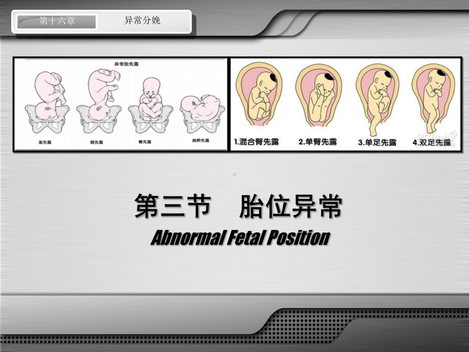 异常分娩-胎位异常课件.ppt_第2页