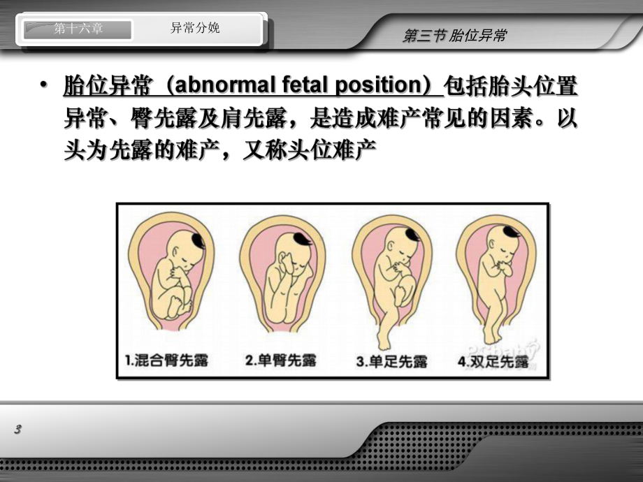 异常分娩-胎位异常课件.ppt_第3页