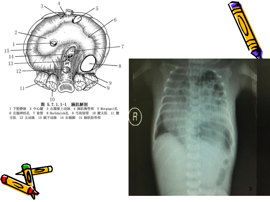 新生儿膈疝PPT课件.ppt_第3页