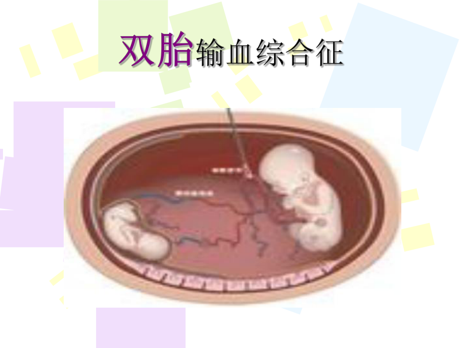 凶险型前置胎盘剖宫产麻醉与输血管理PPT课件.ppt_第1页