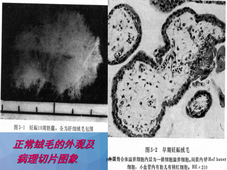 妊娠滋养细胞疾病病人的护理-ppt课件1.ppt_第3页