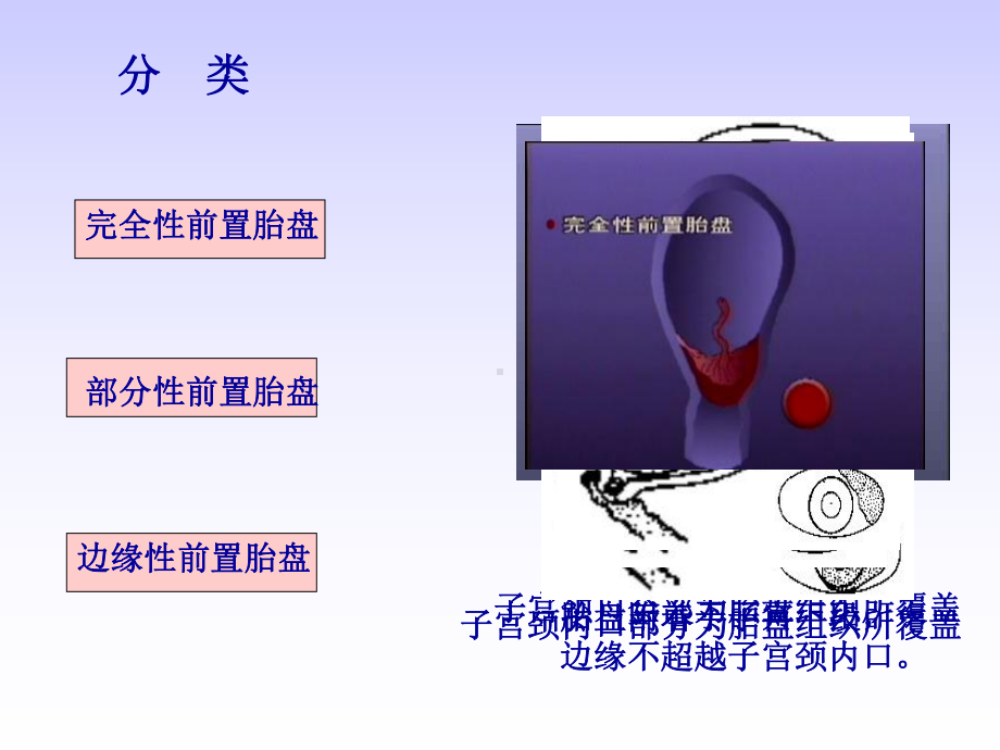 妊娠晚期出血性疾病课件.ppt_第3页