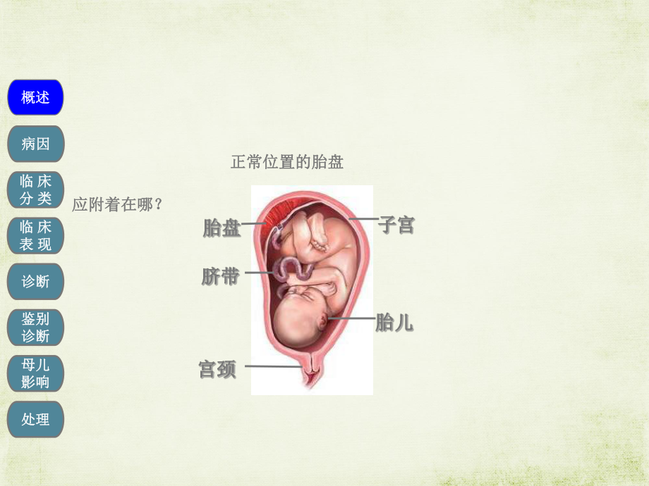 凶险性前置胎盘PPT课件.ppt_第3页