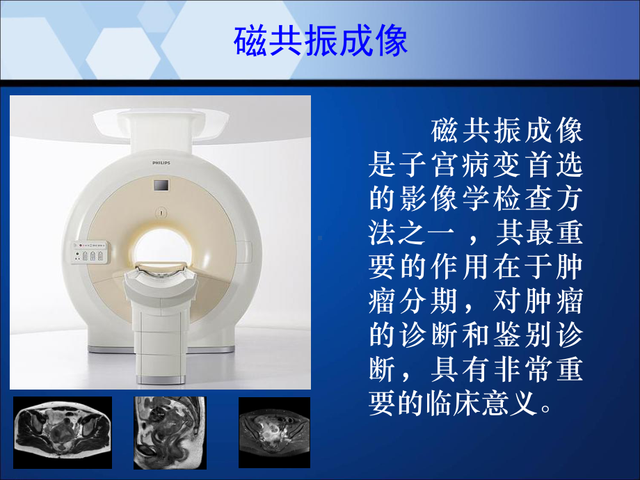 子宫内膜癌MRI影像表现ppt培训课件.ppt_第2页