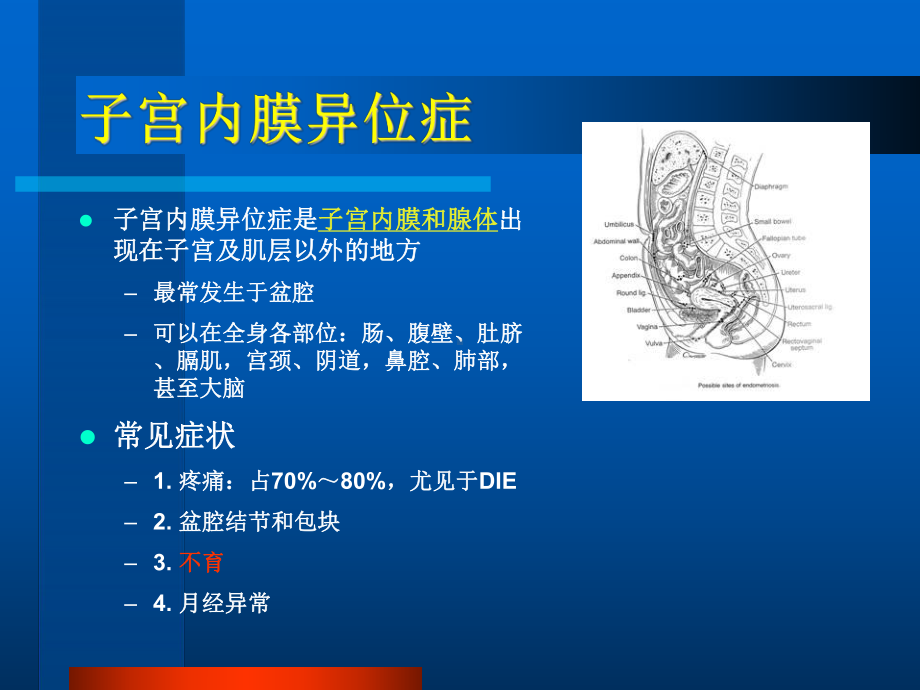 子宫内膜异位症性不孕症诊治 课件.ppt_第2页