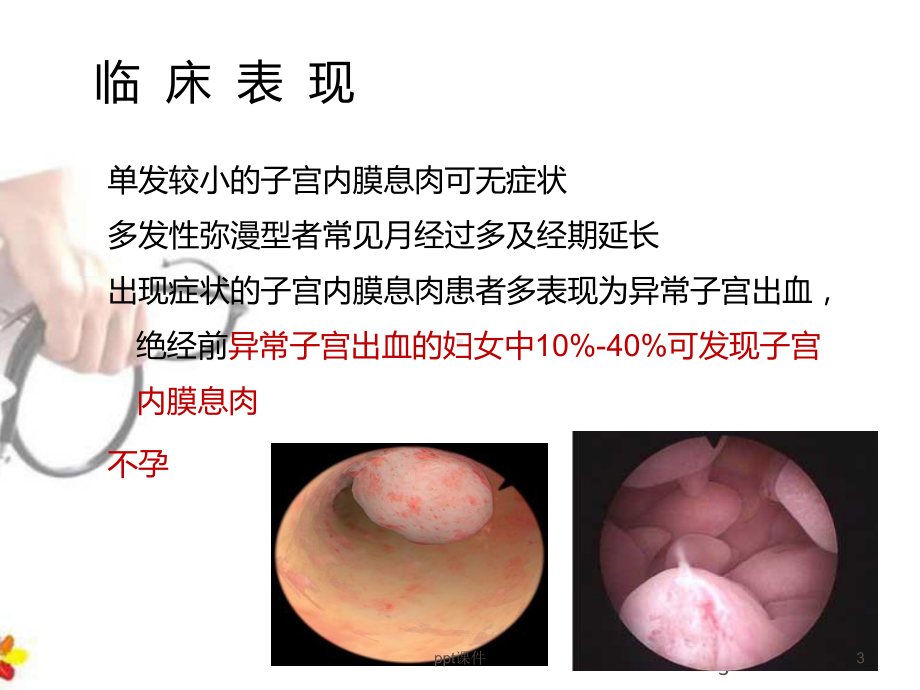 子宫内膜息肉的诊治和复发的预防-ppt课件.ppt_第3页