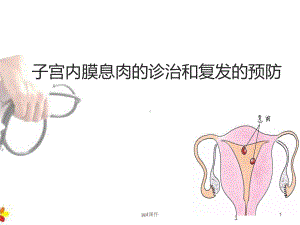 子宫内膜息肉的诊治和复发的预防-ppt课件.ppt