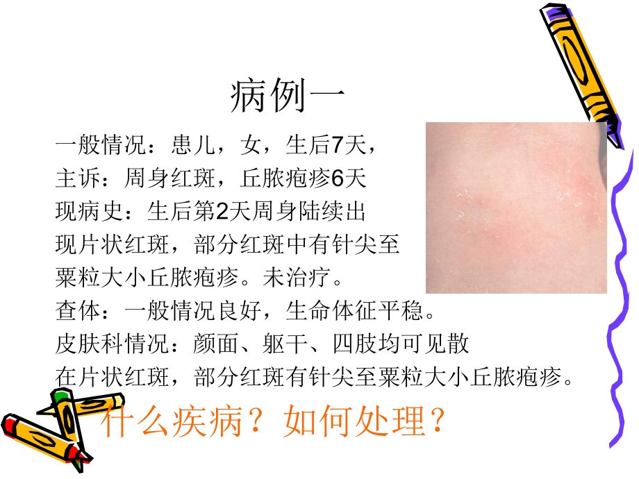 新生儿皮肤病课件.ppt_第3页