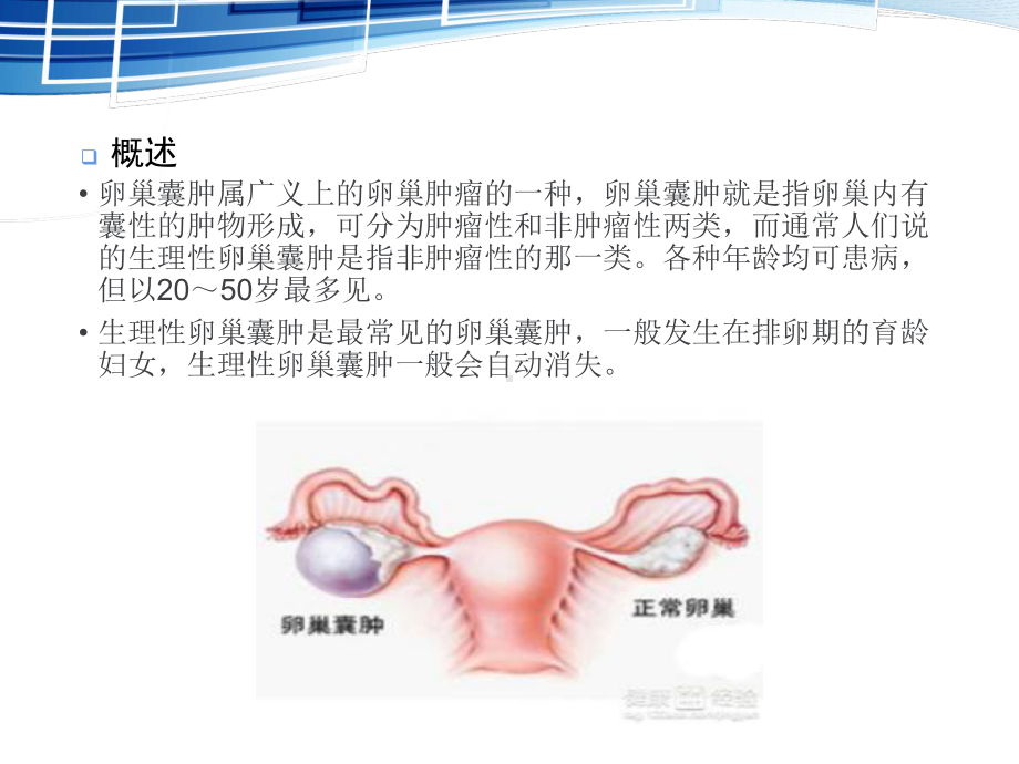 卵巢囊肿PPT课件1.ppt_第3页