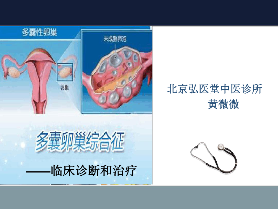 多囊卵巢综合征PPT课件.ppt.ppt_第1页