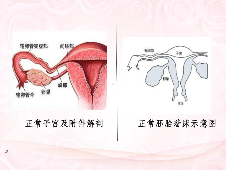 异位妊娠的护理PPT课件2.ppt_第3页