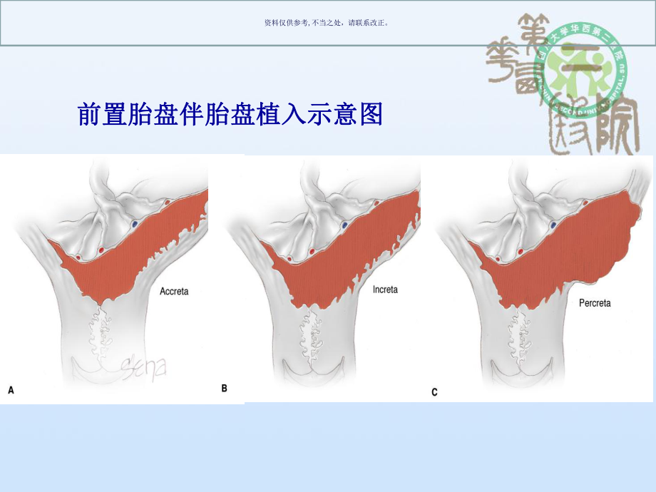 凶险型前置胎盘的诊治策略课件.ppt_第3页