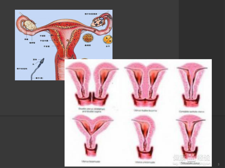 子宫畸形及三维成像PPT课件.ppt_第3页