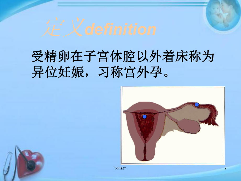 异位妊娠-(3)-ppt课件.ppt_第2页