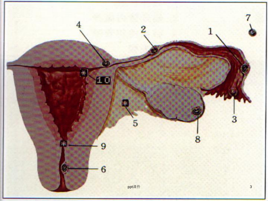 异位妊娠-(3)-ppt课件.ppt_第3页