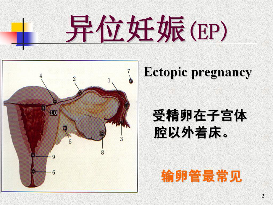 异位妊娠-异位妊娠课件.ppt_第2页