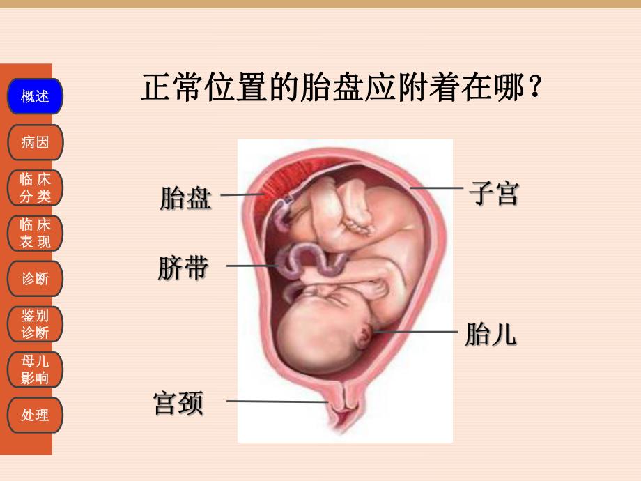 前置胎盘课件2.ppt_第2页