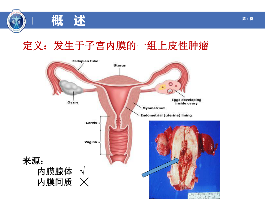 妇产科学-子宫内膜癌课件.ppt_第2页