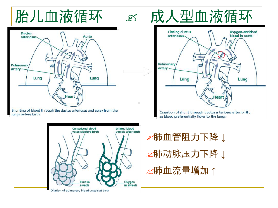 新生儿肺动脉高压1课件.ppt_第3页