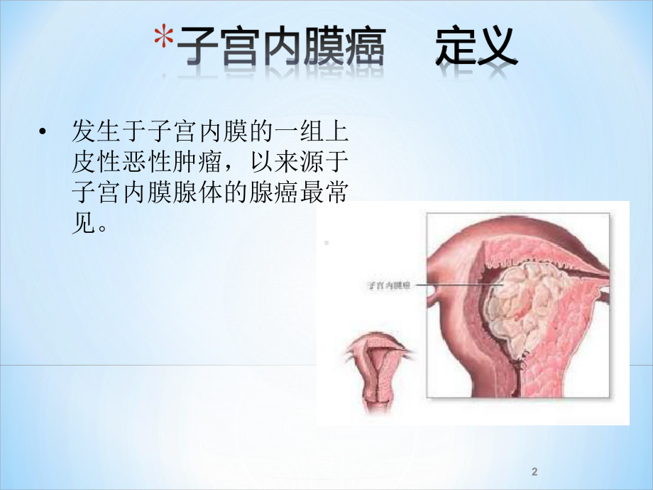 子宫内膜癌病人护理ppt课件.ppt_第2页