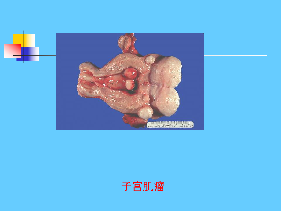 子宫肌瘤PPT课件2.ppt_第3页