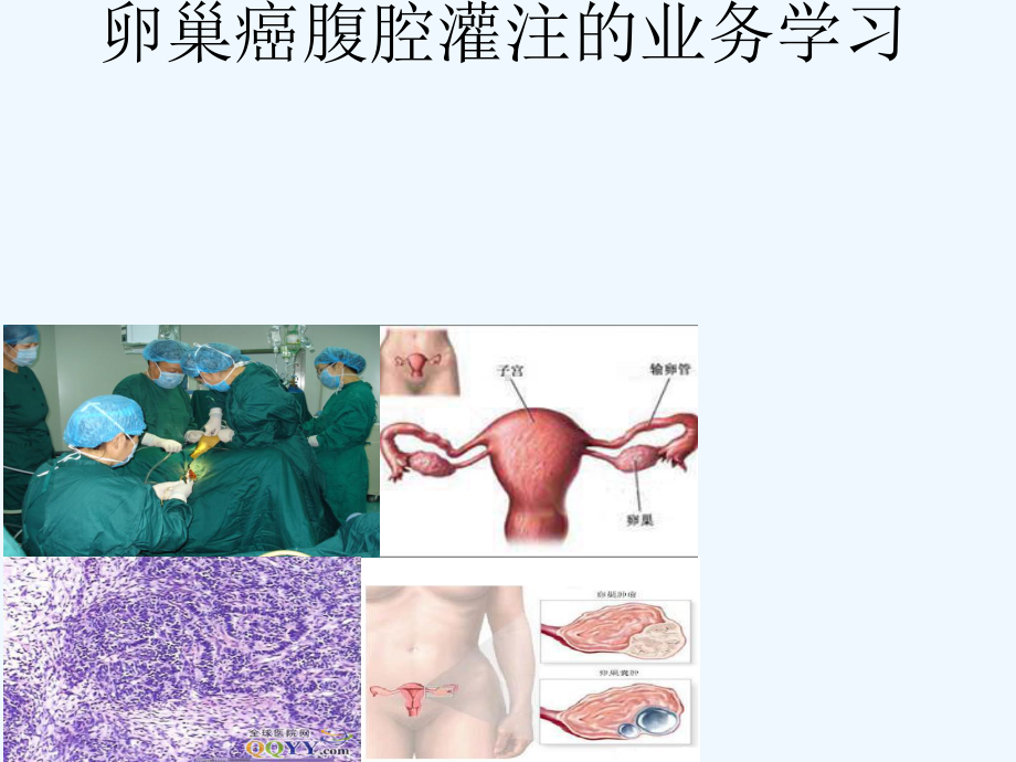 卵巢癌腹腔灌注化疗护理课件.ppt_第1页