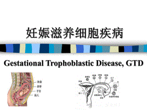 (妇产科学课件）14.2&15.1妊娠滋养细胞疾病2.ppt