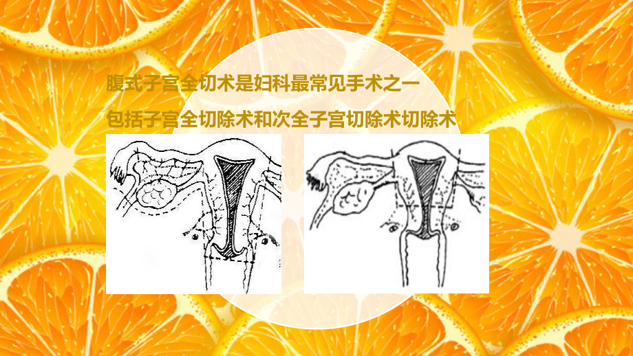 经腹全子宫切除术的手术配合-ppt课件.ppt_第3页