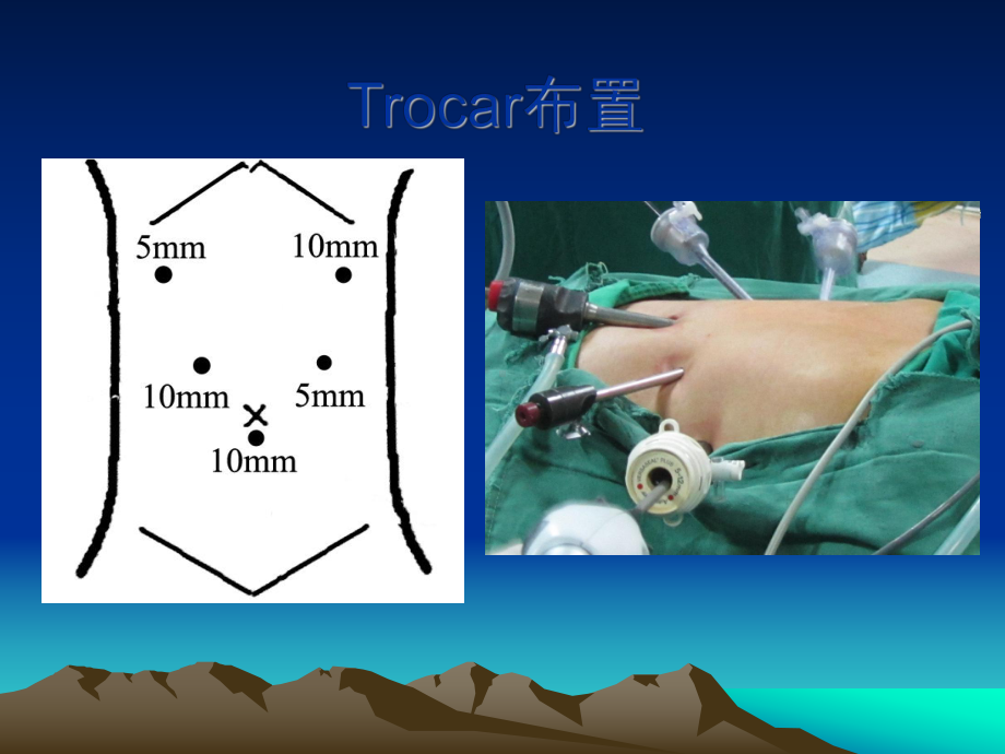 腹腔镜胃癌D2根治术-相关解剖课件.ppt_第2页