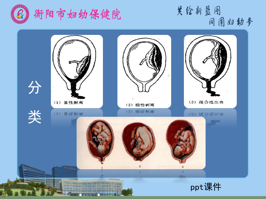 胎盘早剥的观察及护理-ppt课件.ppt_第3页