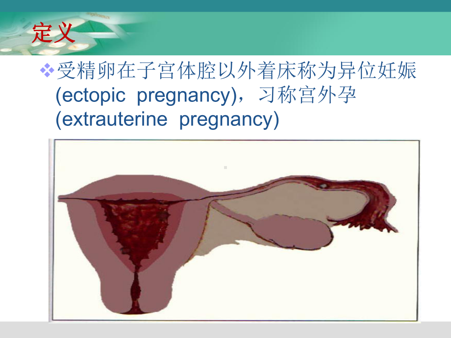 腹腔镜下宫外孕手术的医疗护理配合讲义课件.ppt_第2页