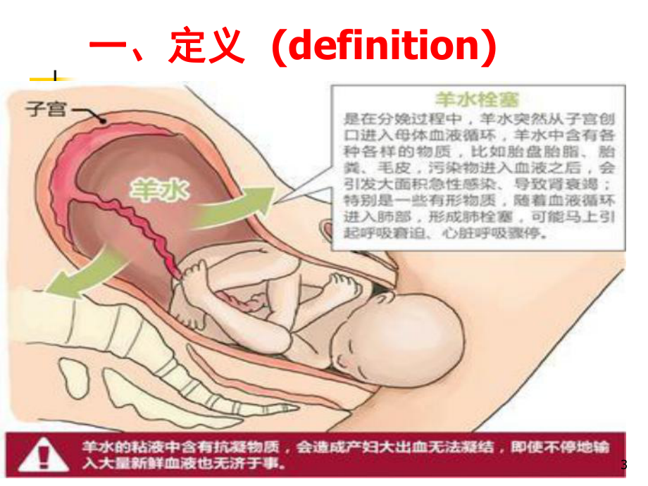 羊水栓塞的最新进展PPT课件.ppt_第3页