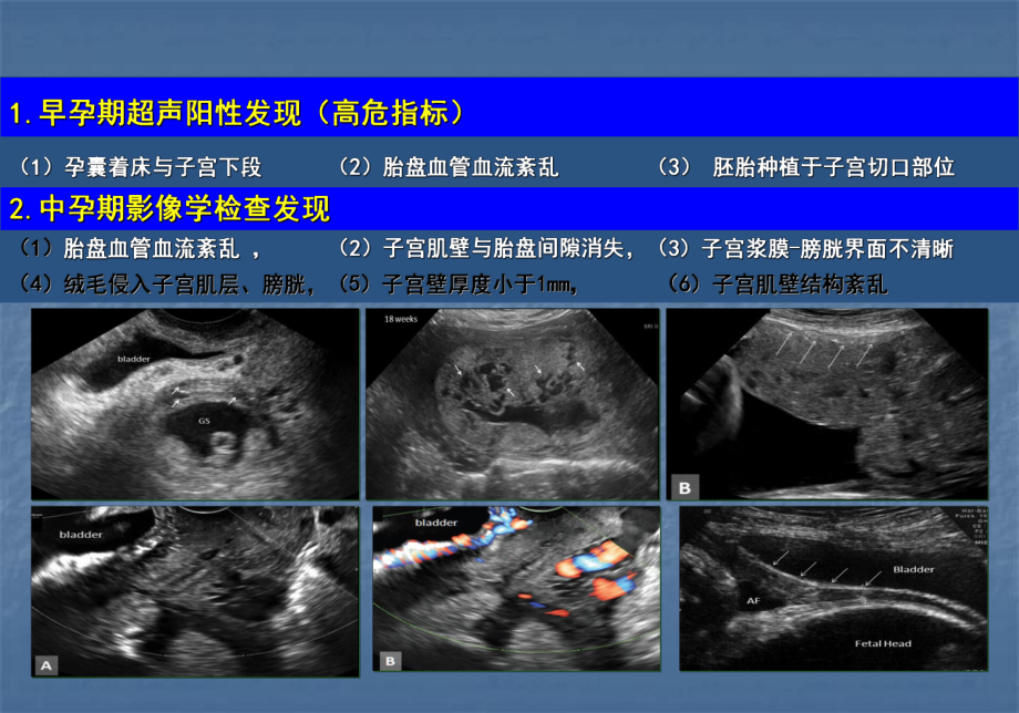 胎盘植入诊治指南PPT课件.ppt_第3页