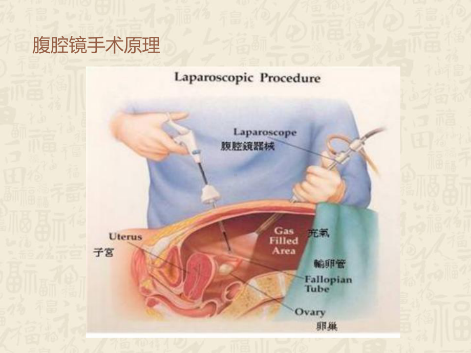 腹腔镜外科应用与发展-ppt课件.ppt_第3页