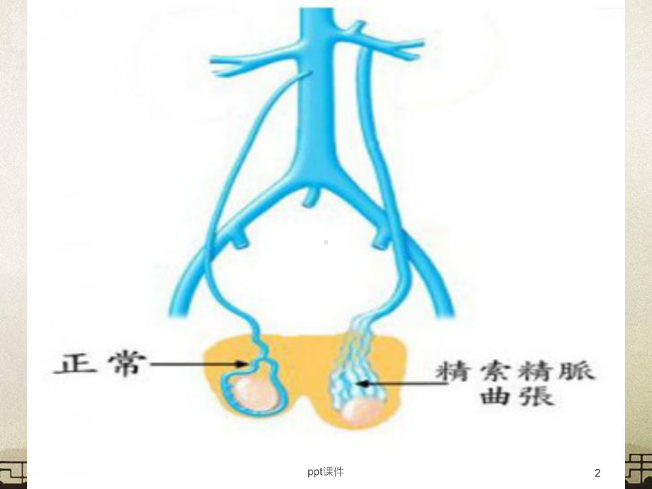 腹腔镜精索静脉曲张切除术护理-ppt课件.ppt_第2页